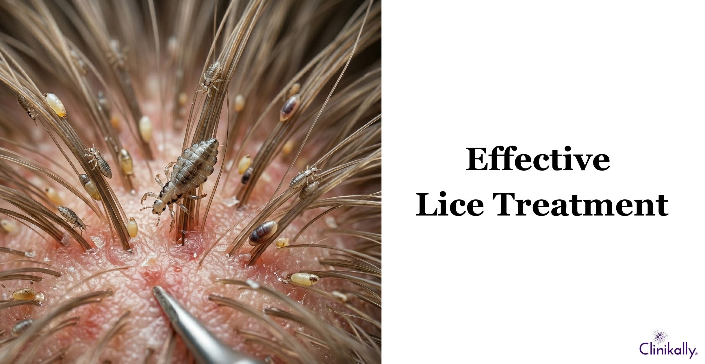 A zoomed image showcasing lice on hair.